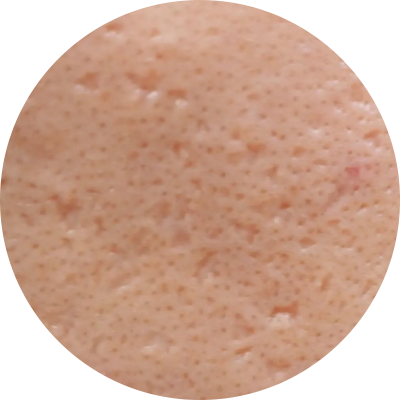 IMG-scar-program-acne-scar-sml