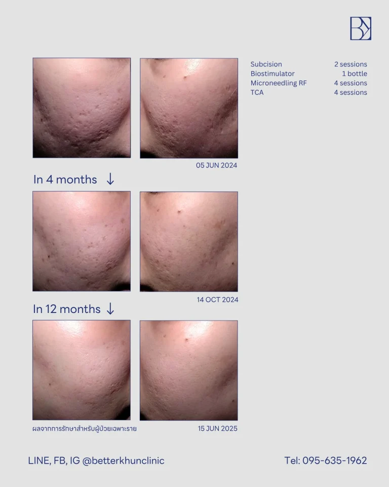 HN000383 วิภาวี