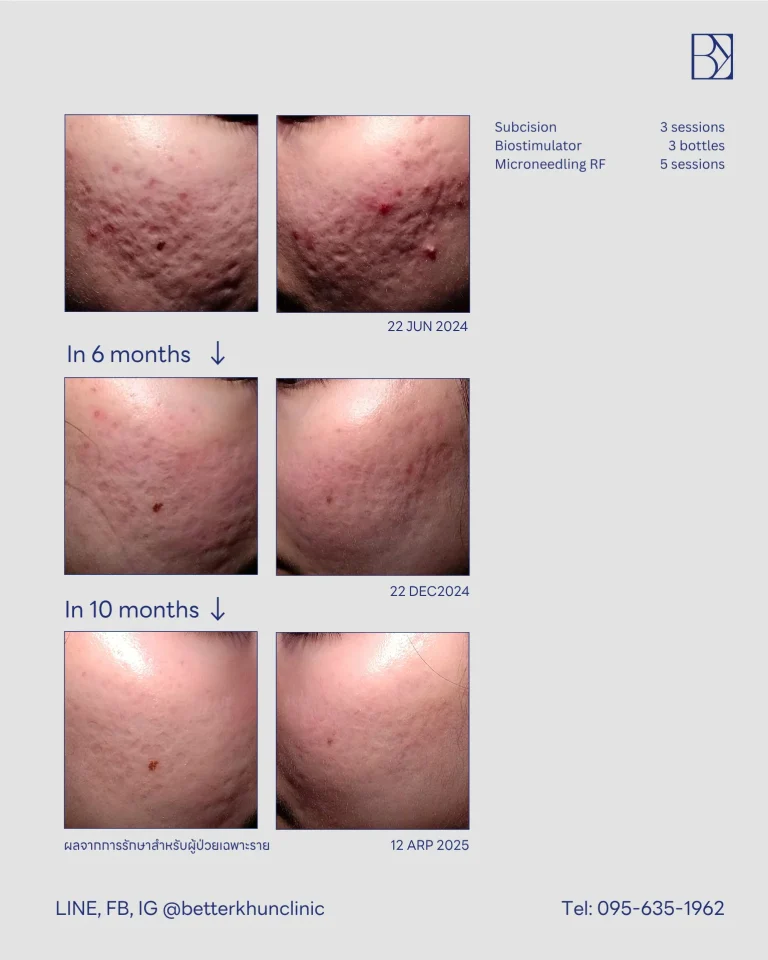 HN000421 จีรัฐถา