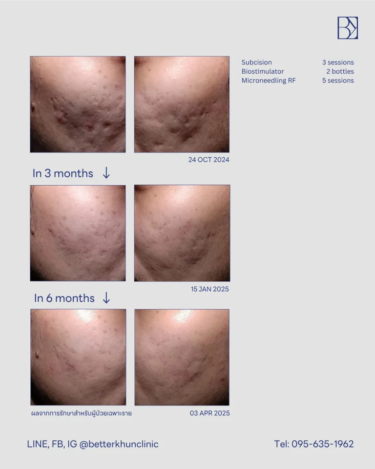 HN000697 จิระประภา