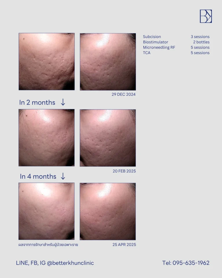 HN000914 พัชรี