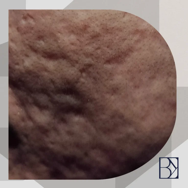 Website - Blog Cover Fat Atrophy