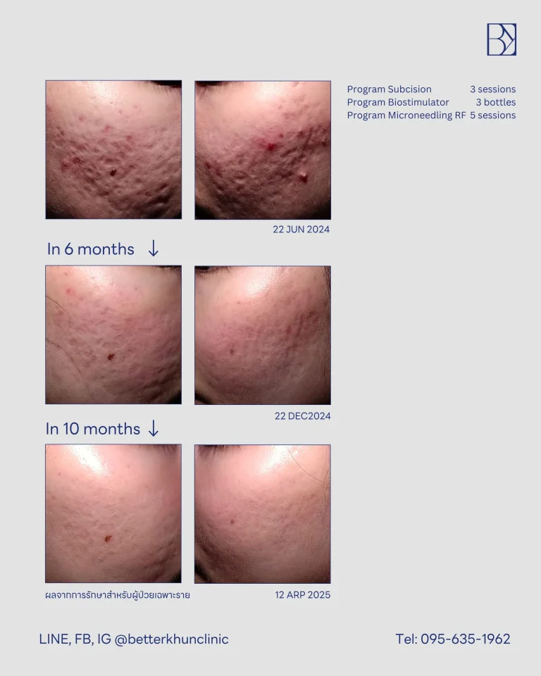 HN000421 จีรัฐถา