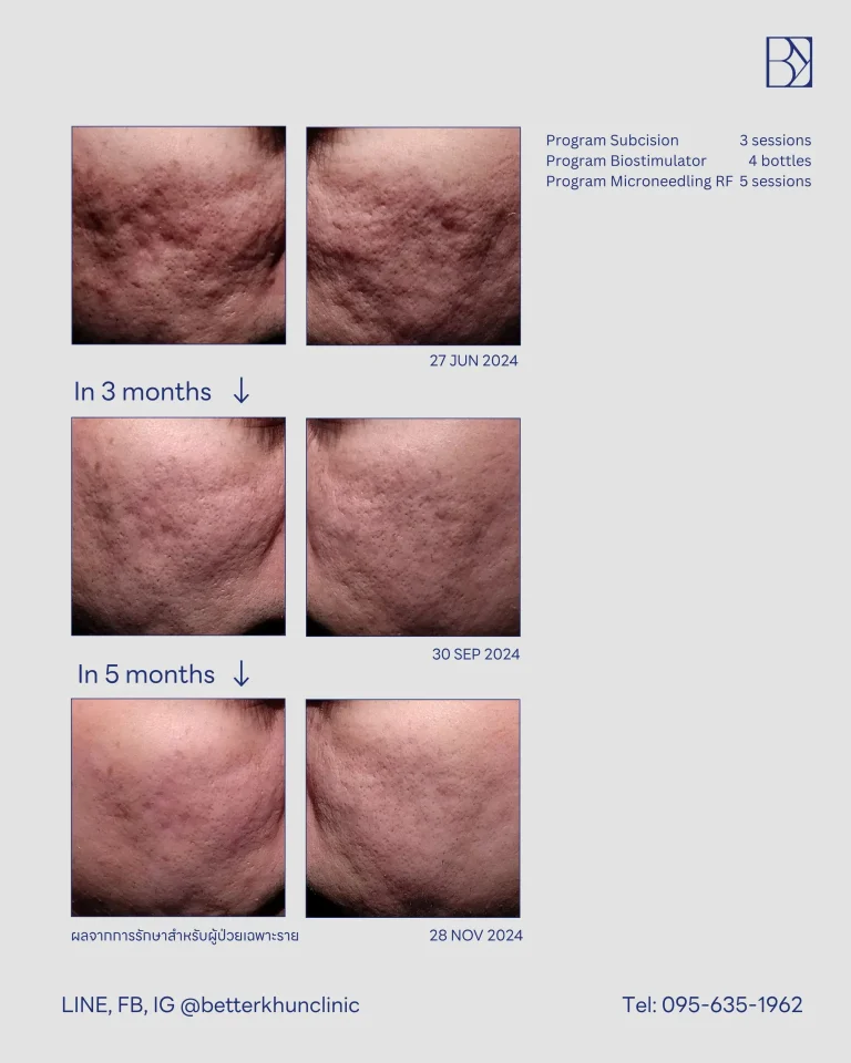 HN000431 พรรษวุฒิ