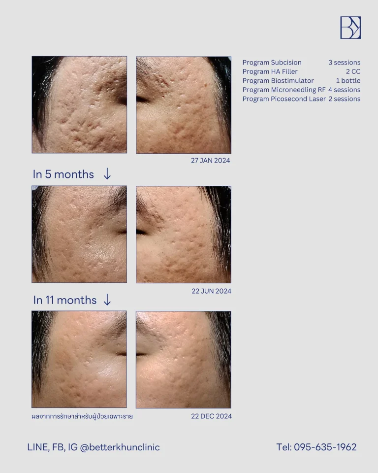 HN000914 พัชรี (2)