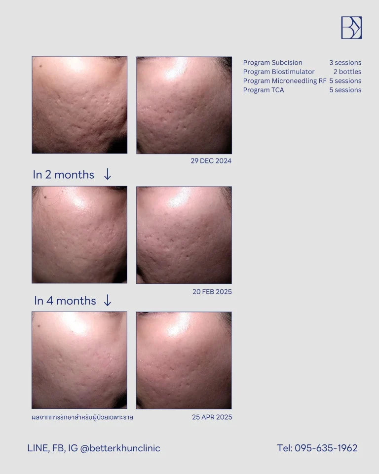 HN000914 พัชรี